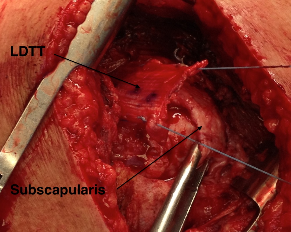 LDTT humeral head